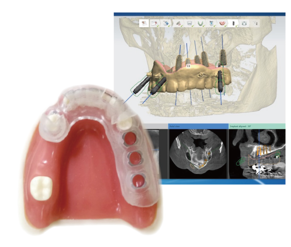サージカルガイド作製サービス